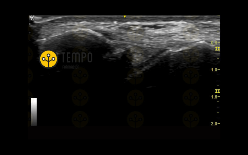 4. Ligamento Peroneo Astragalino Anterior Ecografia Tempo Formación.png